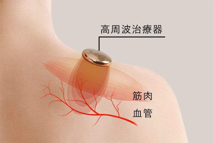 High-Frequency Therapy Device Coricolan EW-RA5 - imy Shop Japan